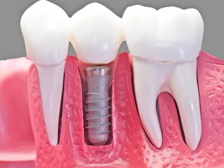Zubni implanti ugradnja