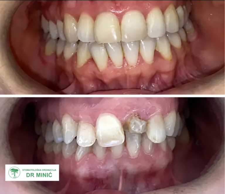 Polomljena gornja jedinica pre i posle rekonstrukcije CEREC krunicom