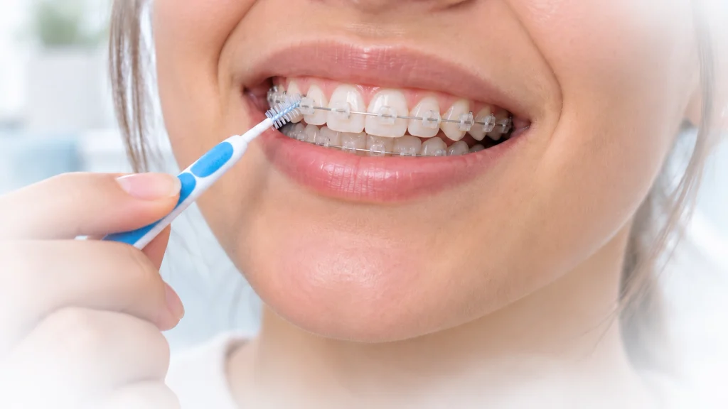 Čišćenje prostora oko bravica i ispod ortodontske žice interdentalnom četkicom
