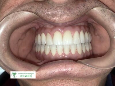 001all-on-four-all-on-six (1)