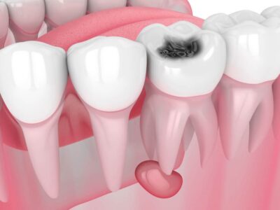 ciste-na-zubima-stomatoloska-ordinacija-dr-minic-beograd-1