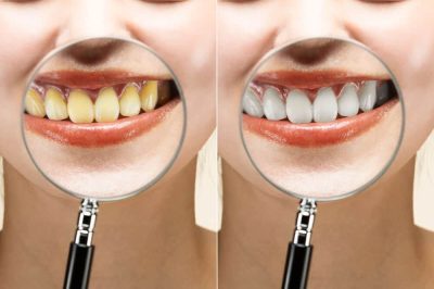 diskoloracija-zuba-stomatoloska-ordinacija-minic-beograd-1