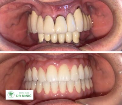 All on Six/All on Four