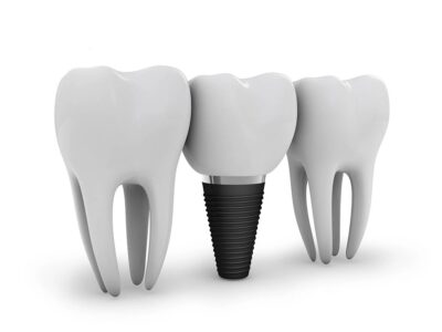 Ugradnja zubnih implantata